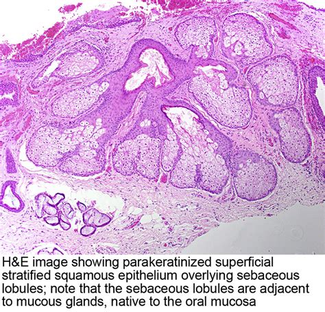 grain de fordyxe|Pathology Outlines